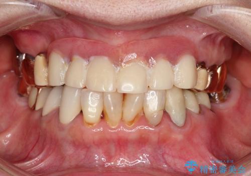下顎の歯周病治療　コーヌスデンチャーを活用した入れ歯の再製作の治療前