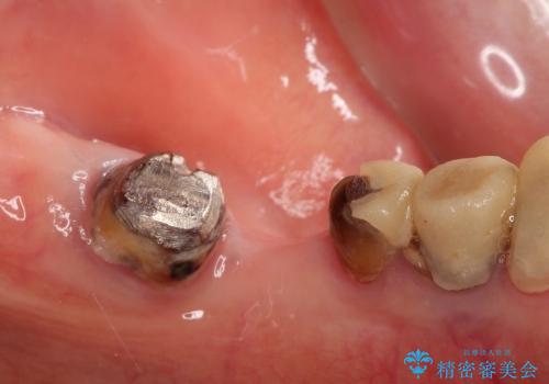 下顎の歯周病治療　コーヌスデンチャーを活用した入れ歯の再製作