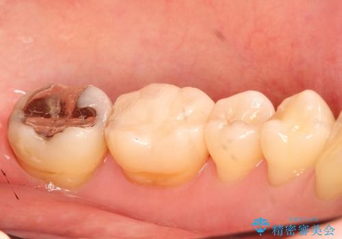 40代女性　金属の下にできた虫歯を処置したいの治療後