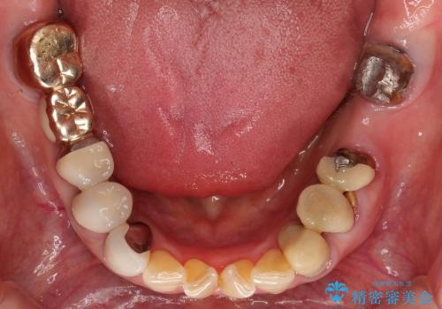 下顎の歯周病治療　コーヌスデンチャーを活用した入れ歯の再製作の治療前