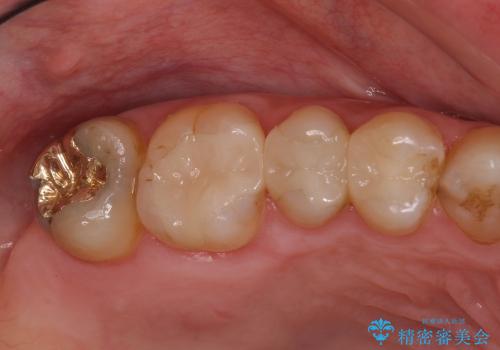 セラミックとゴールドを用いた奥歯のむし歯治療の治療後