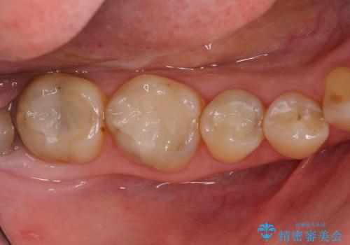 セラミックとゴールドを用いた奥歯のむし歯治療の治療後