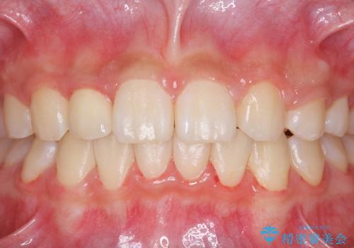 矮小歯　前歯の小さな歯を自然な形にの治療後
