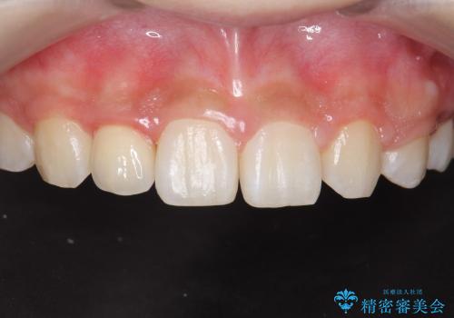 矮小歯　前歯の小さな歯を自然な形にの治療後