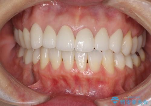 反対咬合　矯正歯科治療と審美歯科治療によりきれいな口元への治療後