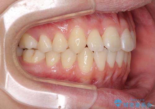 インビザラインによる非抜歯矯正　半年で前歯のがたがたを解消の治療後