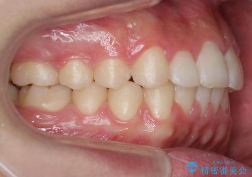 10代男性　出っ歯　歯を抜かない矯正の治療後