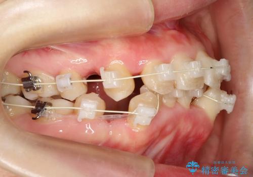 20代女性　ガタガタの歯を矯正してきれいに　表のワイヤー矯正の治療中