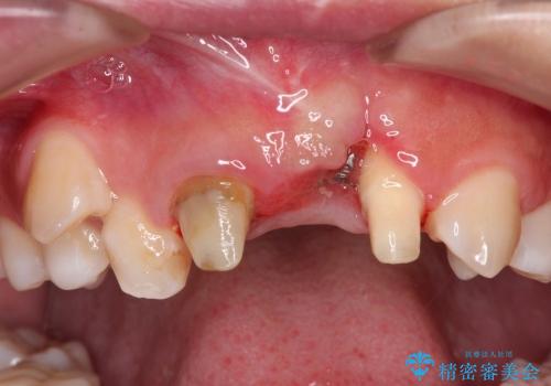 30代女性　ミゼラブルな前歯の陥没を再生する①1次手術による骨造成の治療後