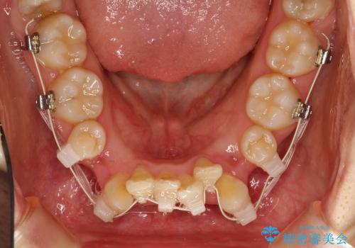 20代女性　ガタガタの歯を矯正してきれいに　表のワイヤー矯正の治療中