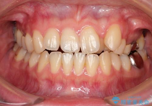 結婚式までに前歯を治したい　上顎骨の拡大を併用した抜歯矯正の治療前