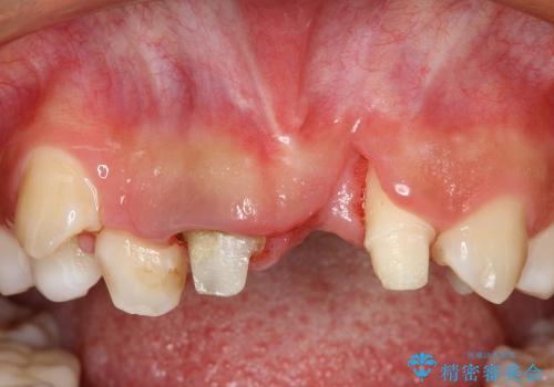 30代女性　ミゼラブルな前歯の陥没を再生する①1次手術による骨造成の治療前