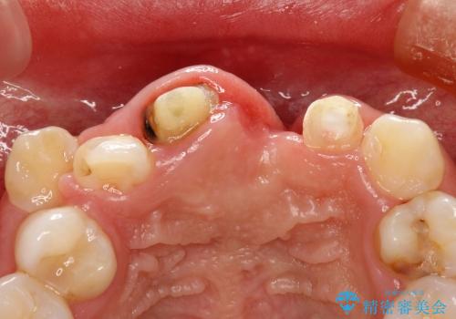 30代女性　ミゼラブルな前歯の陥没を再生する①1次手術による骨造成の治療前