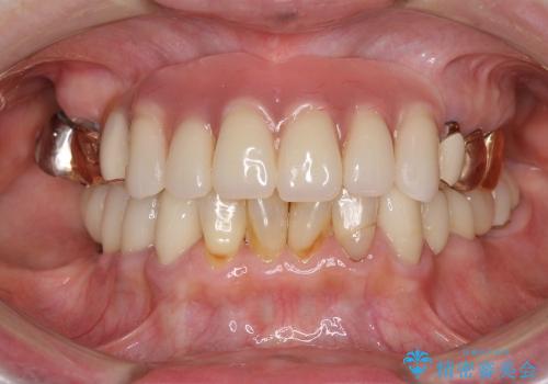 下顎の歯周病治療　コーヌスデンチャーを活用した入れ歯の再製作の治療後