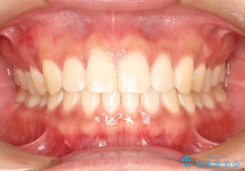 30代男性　前歯のすきまを部分矯正で治したいの症例 治療後