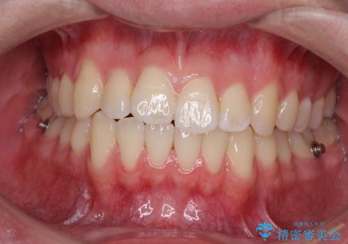 インビザラインによる非抜歯矯正　半年で前歯のがたがたを解消の治療中