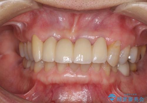 前歯のブリッジがすぐに外れる　まずは土台の歯をしっかりと改善の治療後
