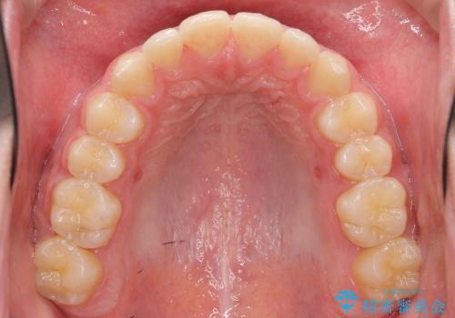 10代男性　出っ歯　歯を抜かない矯正の治療後