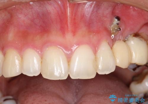 30代女性　前歯部審美ブリッジ修復の治療前