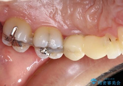30代女性　前歯部審美ブリッジ修復の治療前