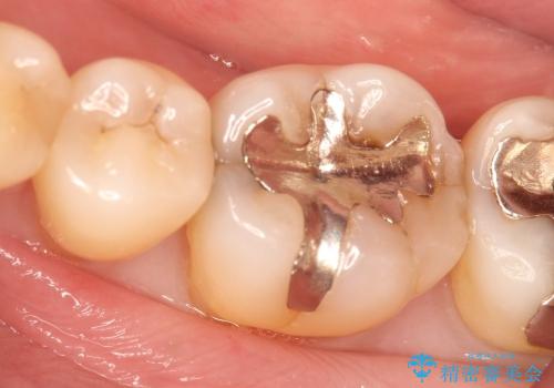 40代女性　金属の下にできた虫歯を処置したいの治療前