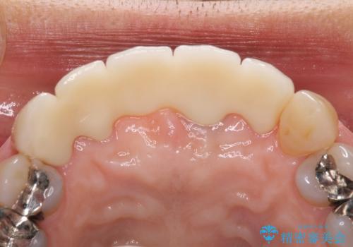 前歯のブリッジがすぐに外れる　まずは土台の歯をしっかりと改善の治療後