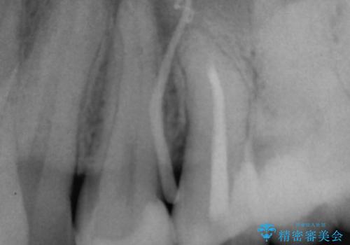 矯正治療前の根管治療 : 歯髄の壊死により、根の先に膿が生じ、歯ぐきに膿の出口ができていたケースへのイニシャルトリートメントの治療前