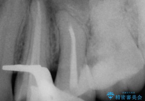 矯正治療前の根管治療 : 歯髄の壊死により、根の先に膿が生じ、歯ぐきに膿の出口ができていたケースへのイニシャルトリートメントの治療中