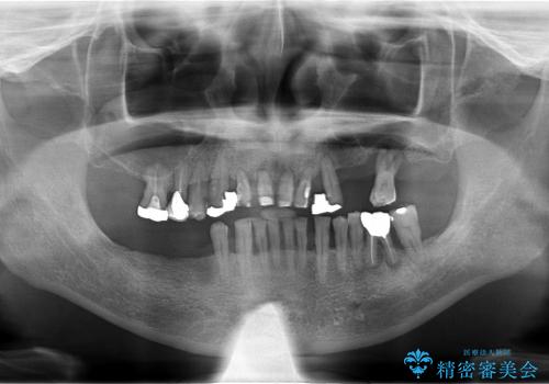 上顎の歯が一本も残せない人のインプラント治療の治療前