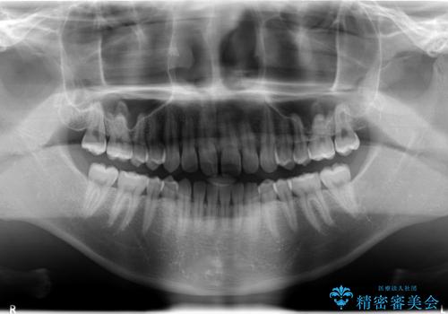 30代男性　前歯のすきまを部分矯正で治したいの治療前