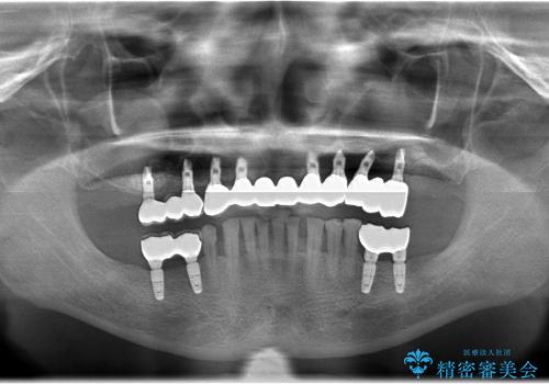 上顎の歯が一本も残せない人のインプラント治療の治療後