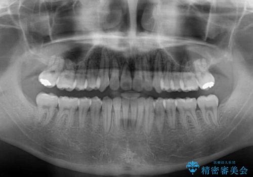 インビザラインによる非抜歯矯正　半年で前歯のがたがたを解消の治療後