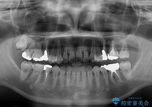 結婚式までに前歯を治したい　上顎骨の拡大を併用した抜歯矯正の治療後