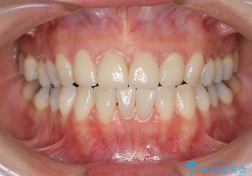 [オールセラミックジルコニアクラウン]  前歯の見た目改善セラミック治療の治療後