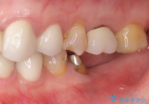 インプラントによる奥歯の咬合機能回復　クラウン高径のない場合骨外科による対応の治療前