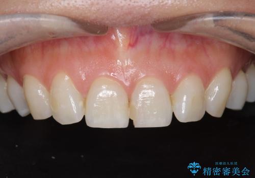 [オールセラミックジルコニアクラウン]  前歯の見た目改善セラミック治療の治療前
