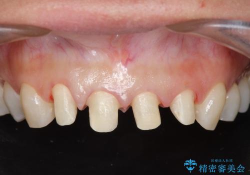 [オールセラミックジルコニアクラウン]  前歯の見た目改善セラミック治療の治療中