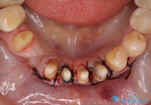 [ 前歯の歯周病治療① ]  再生治療・歯周ポケット除去の治療後