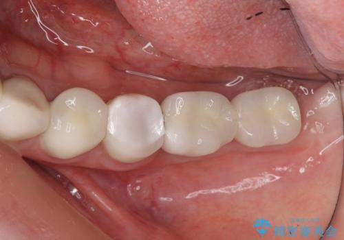 インプラントによる奥歯の咬合機能回復　クラウン高径のない場合骨外科による対応の治療後