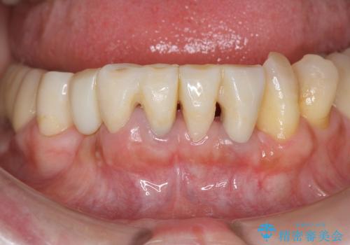 [ 前歯の歯周病治療② ]  再生治療後の歯ぐきの治癒・セラミッククラウンの作製の治療中