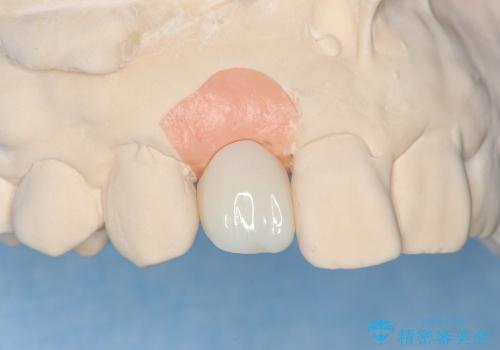 [ 骨造成を伴う前歯審美インプラント① ] インプラント埋入→2次手術の治療後