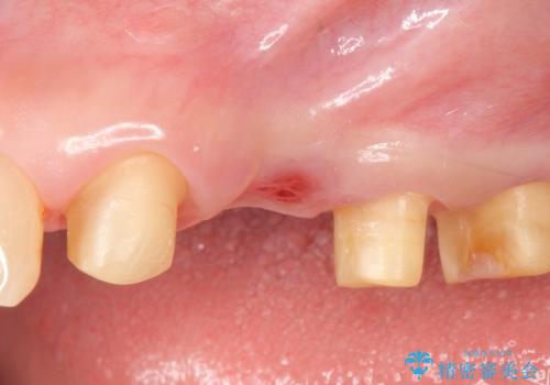 歯ぎしりで歯がグラグラ　噛み合わせを改善するブリッジ治療の治療中