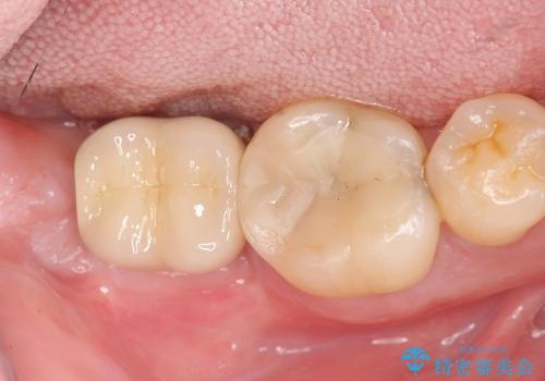 失った奥歯　インプラントによる咬合機能回復の治療後