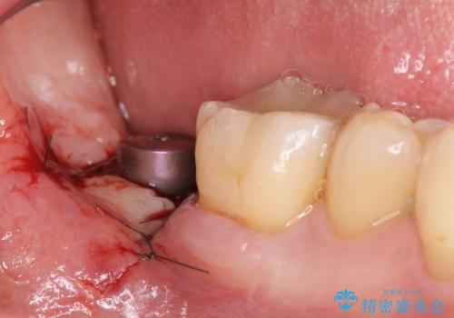 失った奥歯　インプラントによる咬合機能回復の治療中