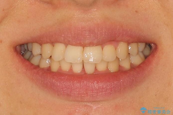 20代女性　ガタガタの歯を矯正してきれいに　表のワイヤー矯正の治療後（顔貌）