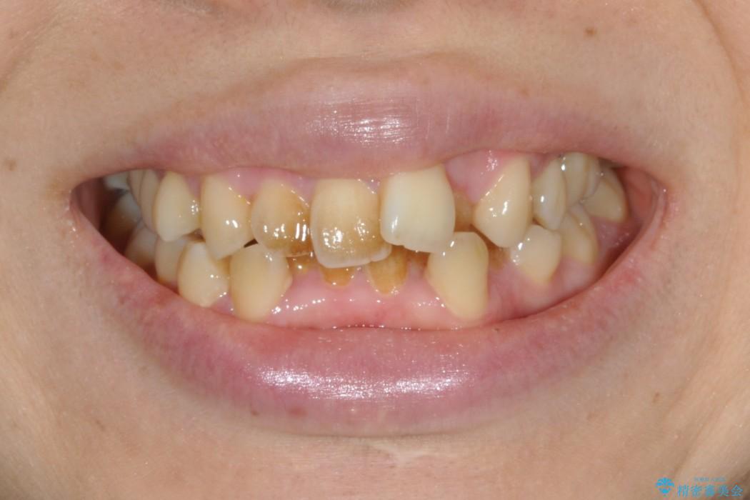20代女性　ガタガタの歯を矯正してきれいに　表のワイヤー矯正の治療前（顔貌）