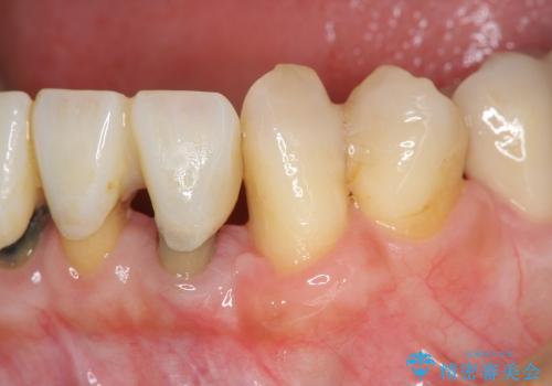 [ 前歯の歯周病治療② ]  再生治療後の歯ぐきの治癒・セラミッククラウンの作製の治療前