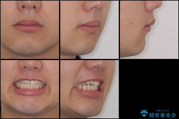 インビザラインによる非抜歯矯正　半年で前歯のがたがたを解消の治療前（顔貌）