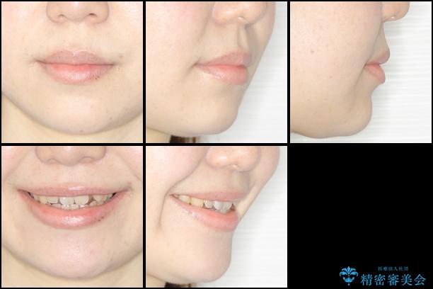 結婚式までに前歯を治したい　上顎骨の拡大を併用した抜歯矯正の治療前（顔貌）