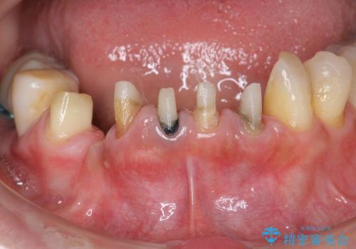 [ 前歯の歯周病治療② ]  再生治療後の歯ぐきの治癒・セラミッククラウンの作製の治療前